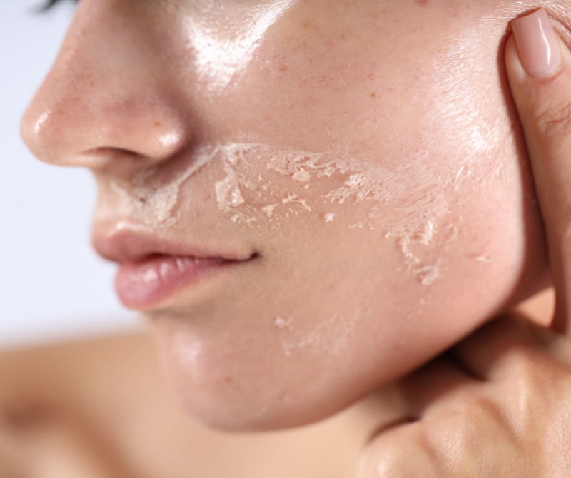 Peau sèche chez la femme